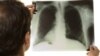 Organizações internacionais lançam apelo a mais fundos para a Tuberculose